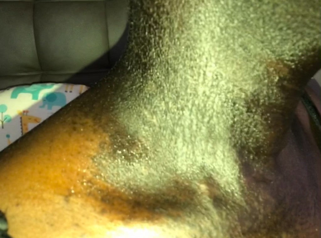 During treatment